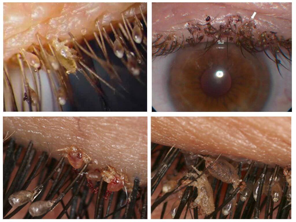 Ciliary Lice and Nits