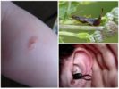 Earwig bite