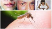 Möjliga konsekvenser av en bit av en malaria mygga