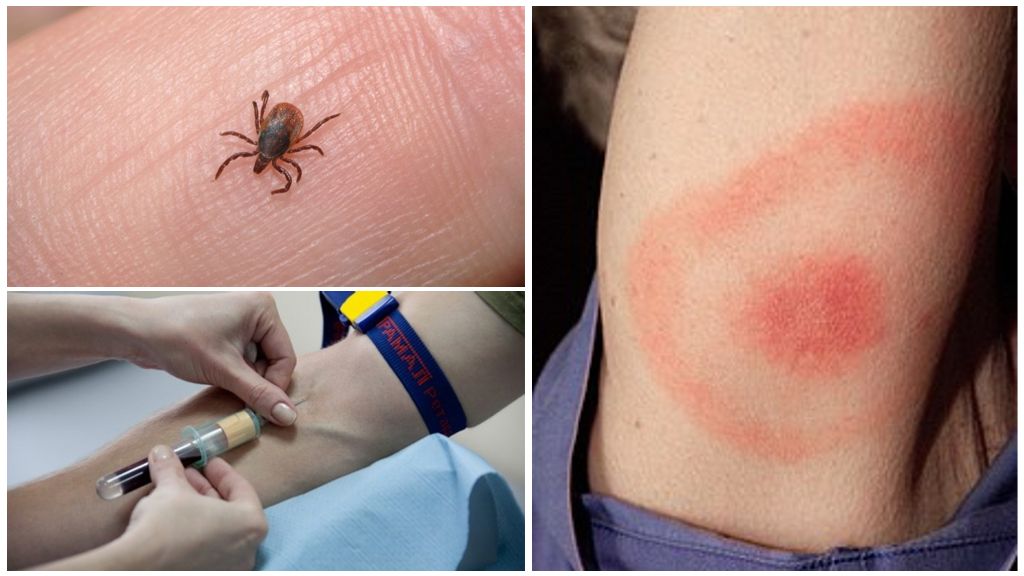 Blodtest för borrelios