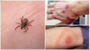 Tick ​​Tick Bite Disease