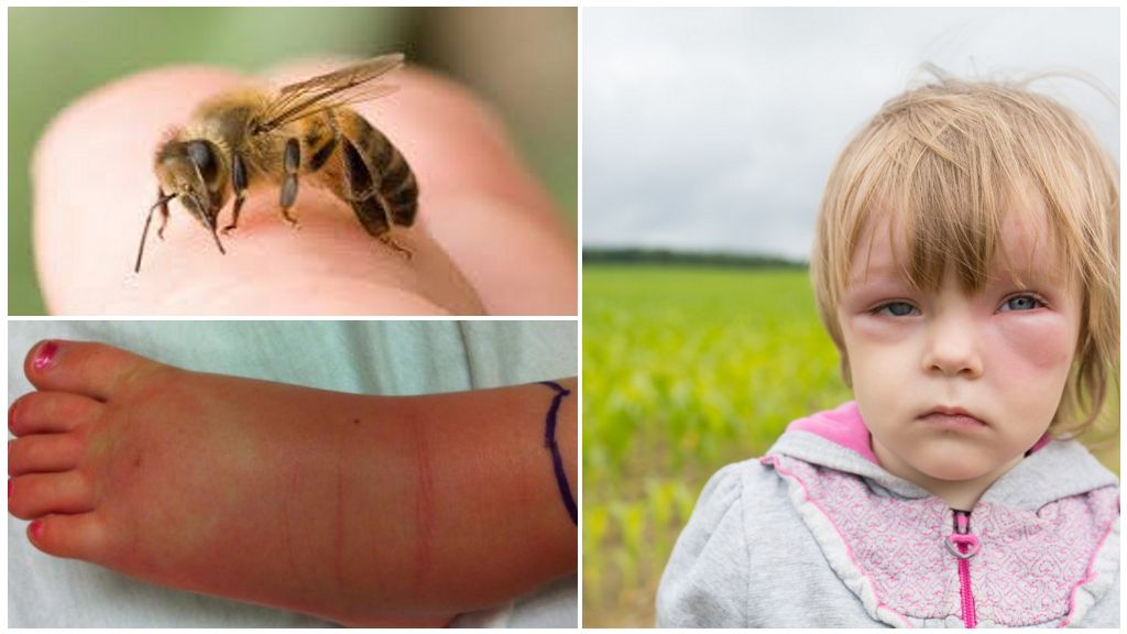 Allergisk reaktion på insektsbett