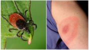 Tick ​​Tick Borreliosis