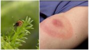 Tick ​​Tick Borreliosis