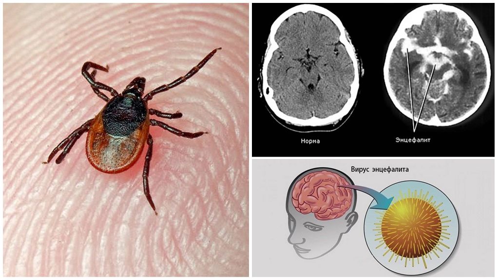 Laboratoriediagnos av fästingburen encefalit och borrelios