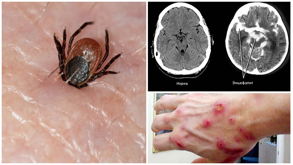 Fästingburen encefalit och borrelios