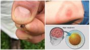 Tick ​​Tick Disease