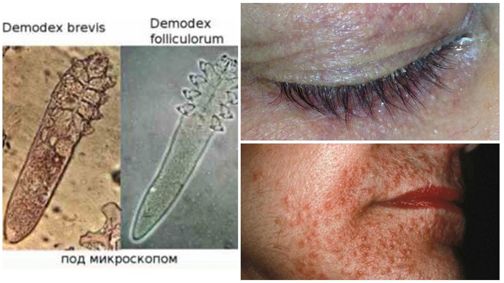 Foto, beskrivning och behandling av hudmidd Demodex