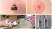 Tick ​​Bite Remedies